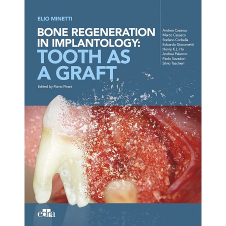 Bone regeneration in implantology: tooth as a graft - dentistry book - cover book - Flavio Pisani - Elio Minetti